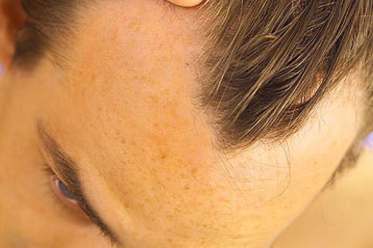 &nbsp;Calvizie incipiente