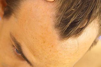 &nbsp;Calvizie incipiente