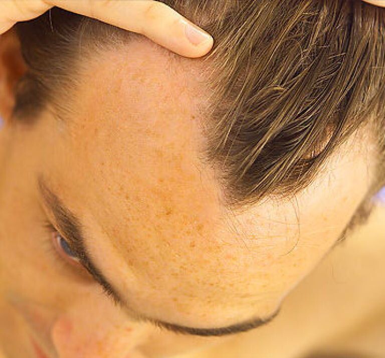 &nbsp;Calvizie incipiente