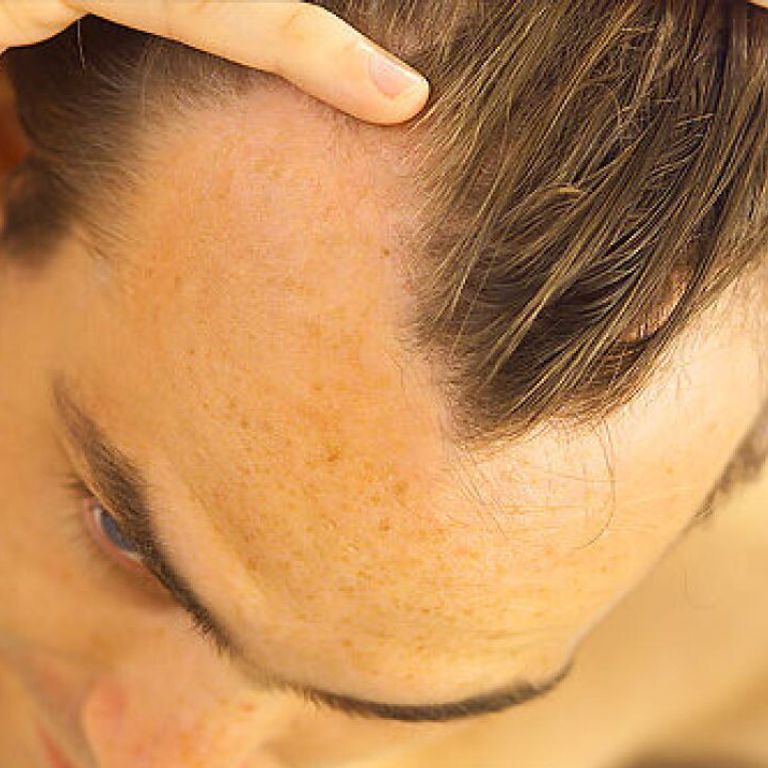 &nbsp;Calvizie incipiente