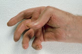 &nbsp;artrite reumatoide (Agf)
