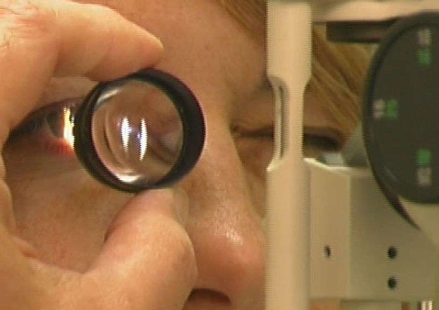 Medicina: glaucoma acuto e' una malattia infiammatoria