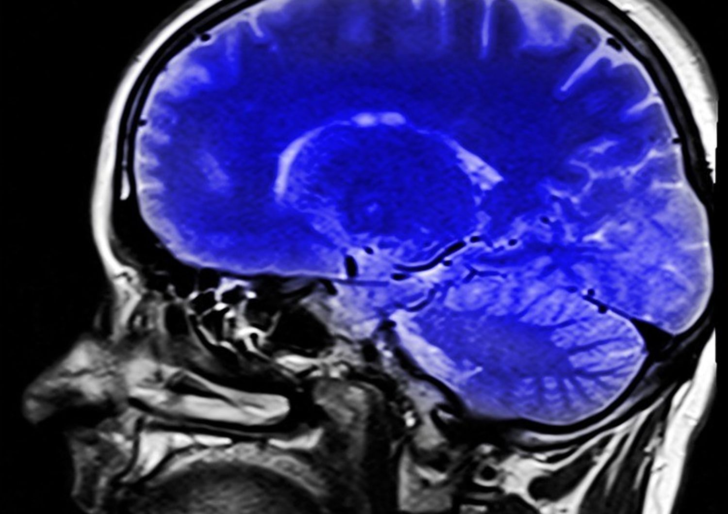 &nbsp;cervello testa cranio risonanza magnetica - pixabay
