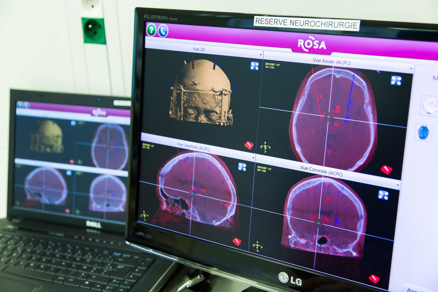 &nbsp;morbo di Parkinson - afp