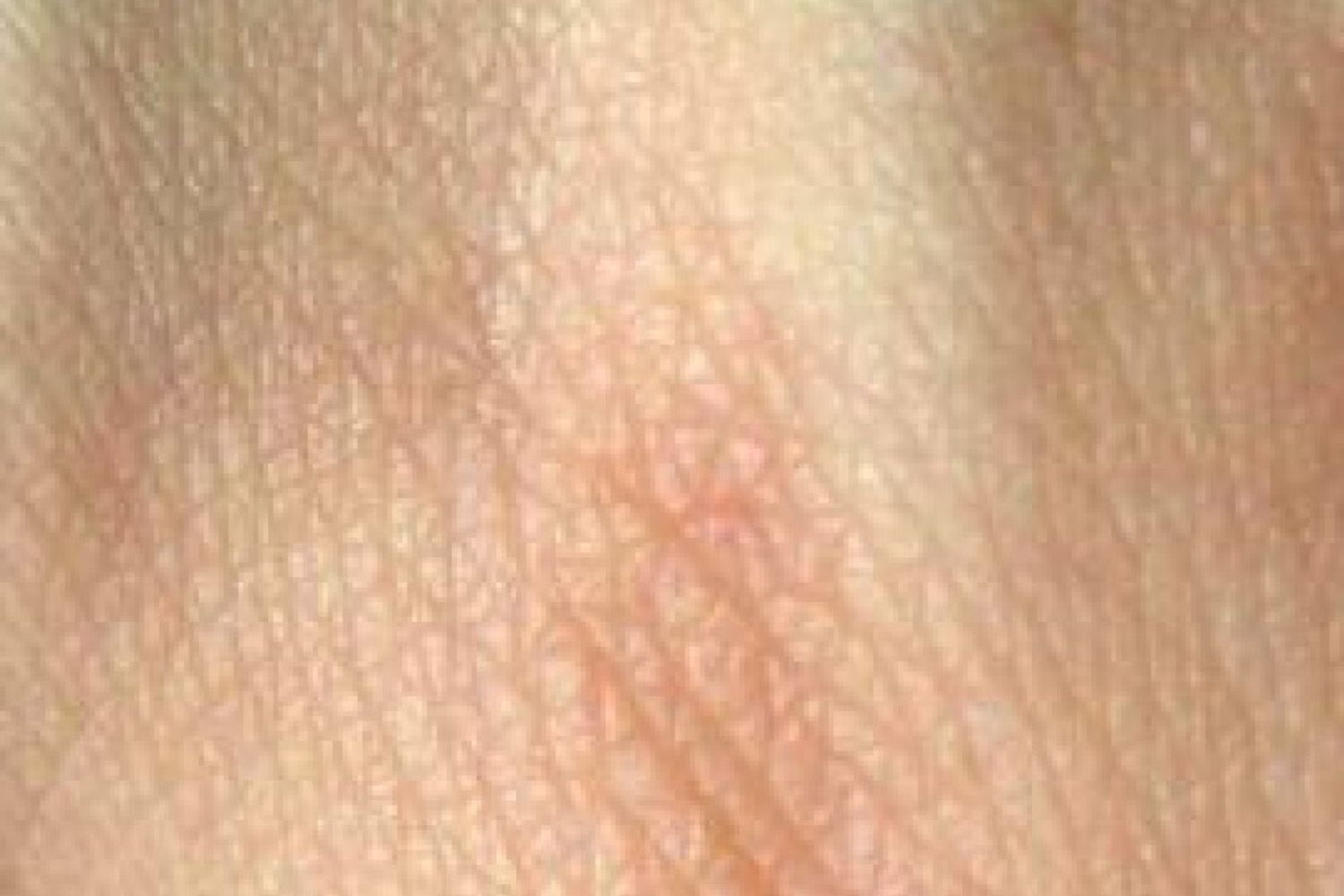 &nbsp;Pelle tumore macchie