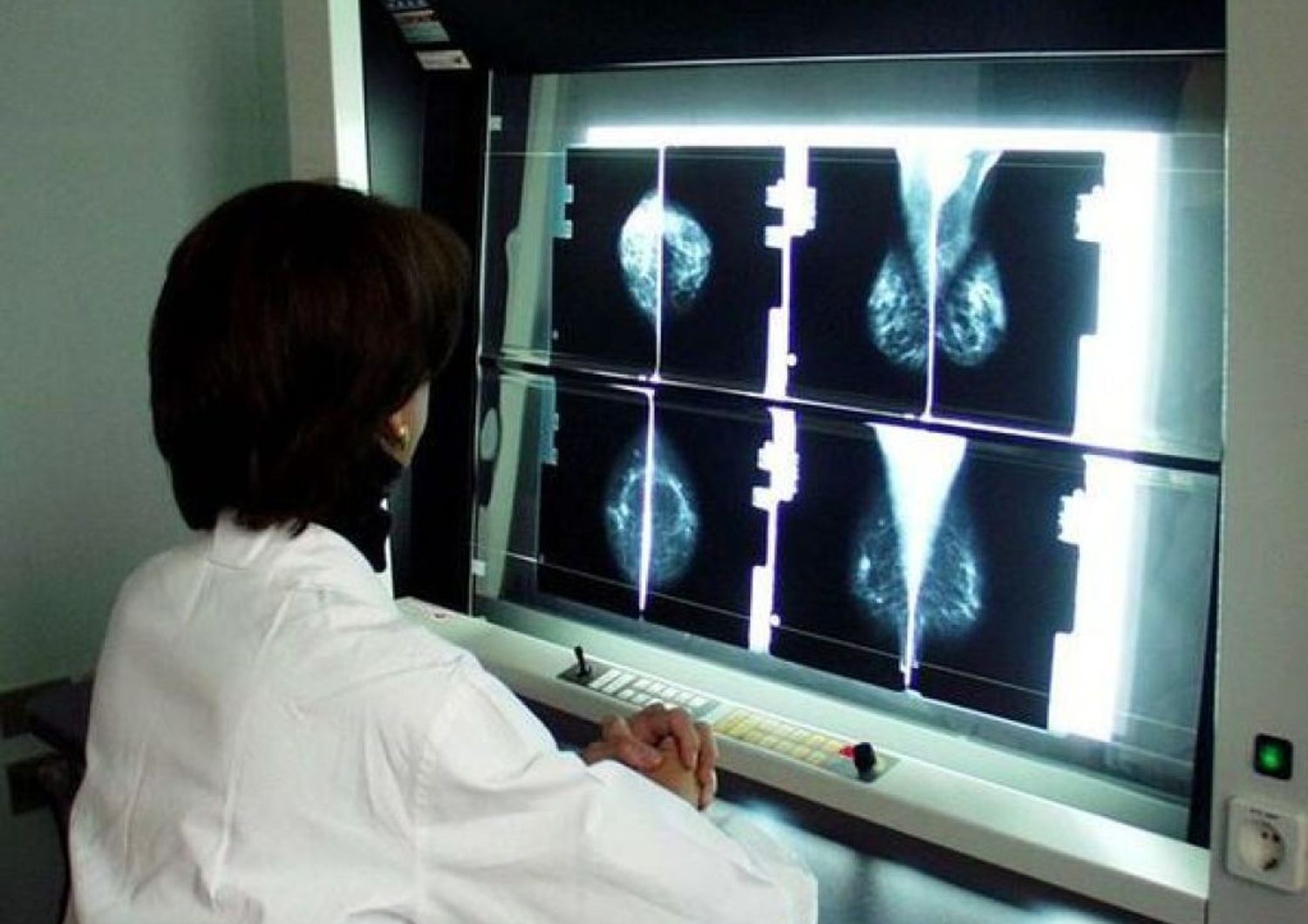 &nbsp;tumore cancro al seno lastre radiografie