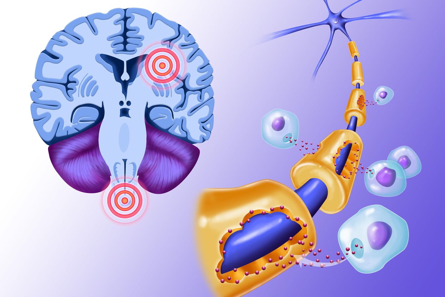 Sla scerosi multipla - afp