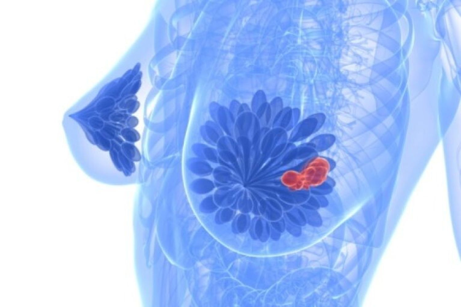 &nbsp; tumore cancro al seno