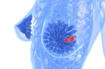 &nbsp; tumore cancro al seno