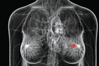 tumore cancro al seno