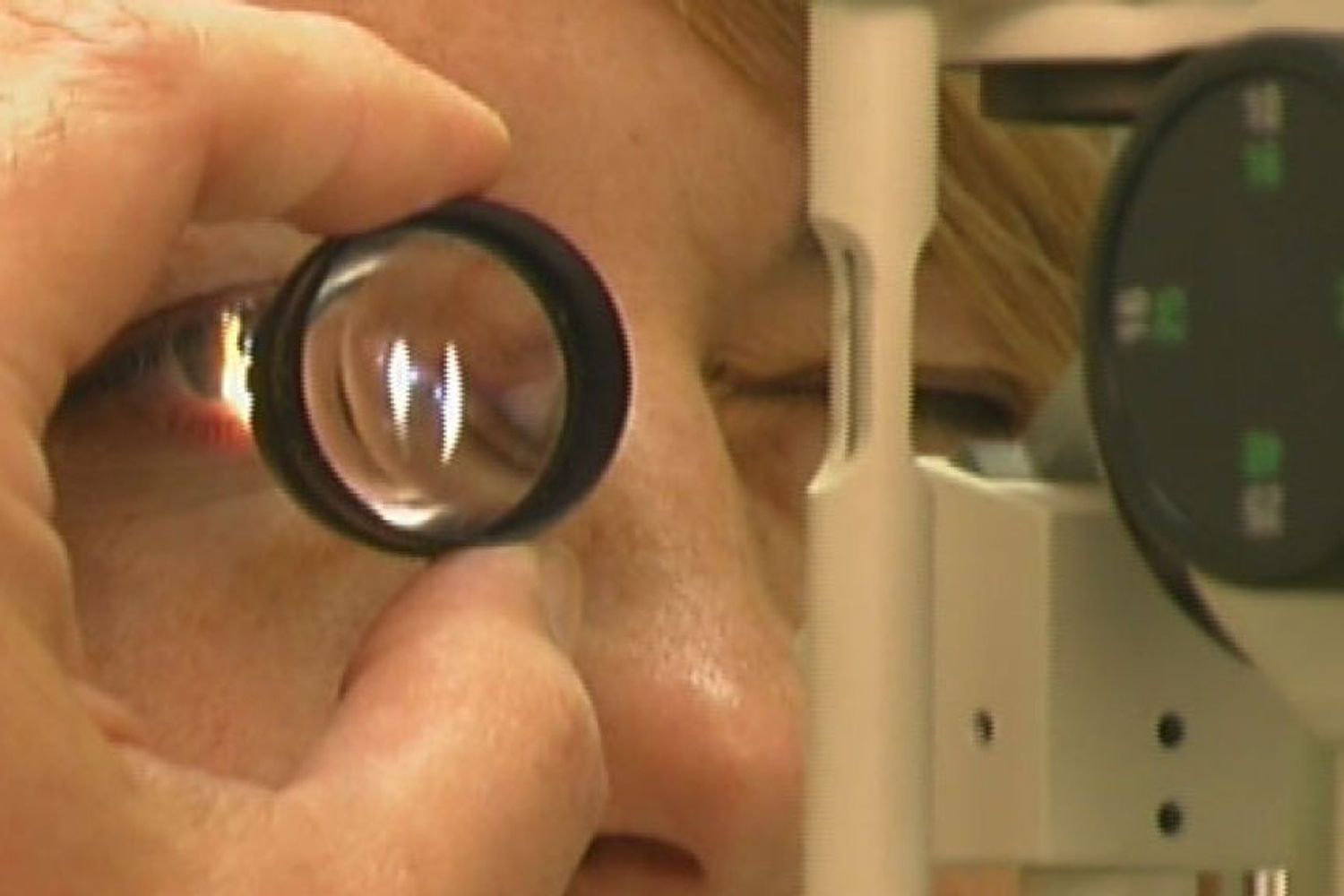 &nbsp;Glaucoma&nbsp;