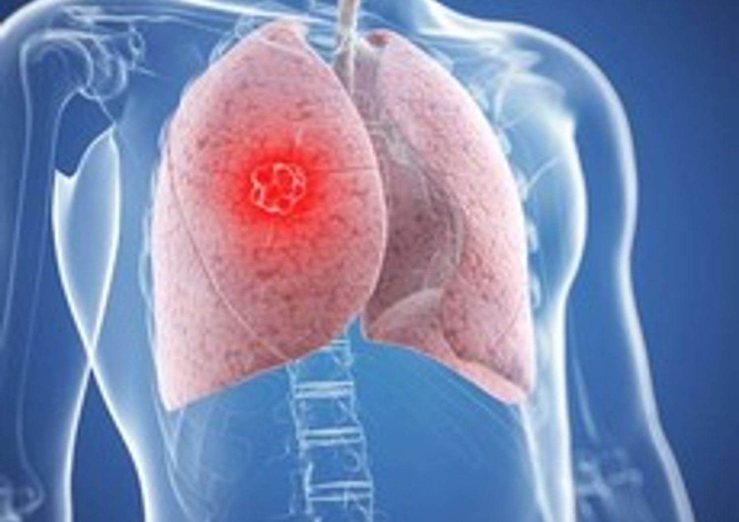 Tumore polmone