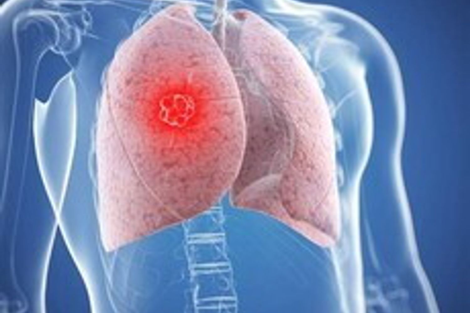 Tumore polmone