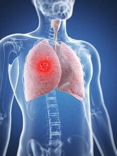 Tumore polmone