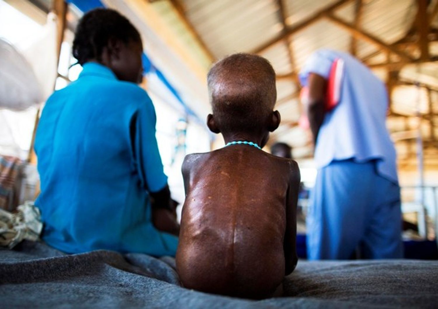 &nbsp;Sud Sudan fame malnutrizione denutrizione fame - afp