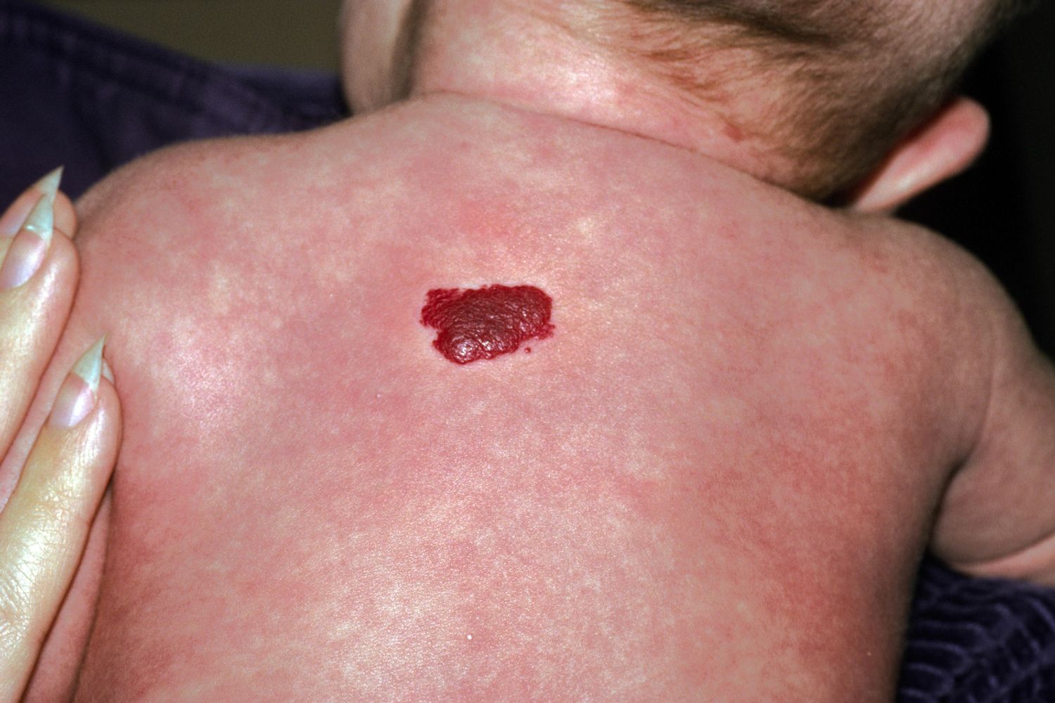 emangiomi infantili (agf)&nbsp;