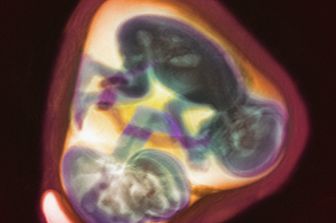 &nbsp;Placenta, neonato