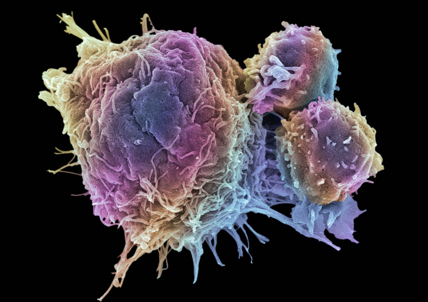 &nbsp;cellule tumorali tumore cancro - afp