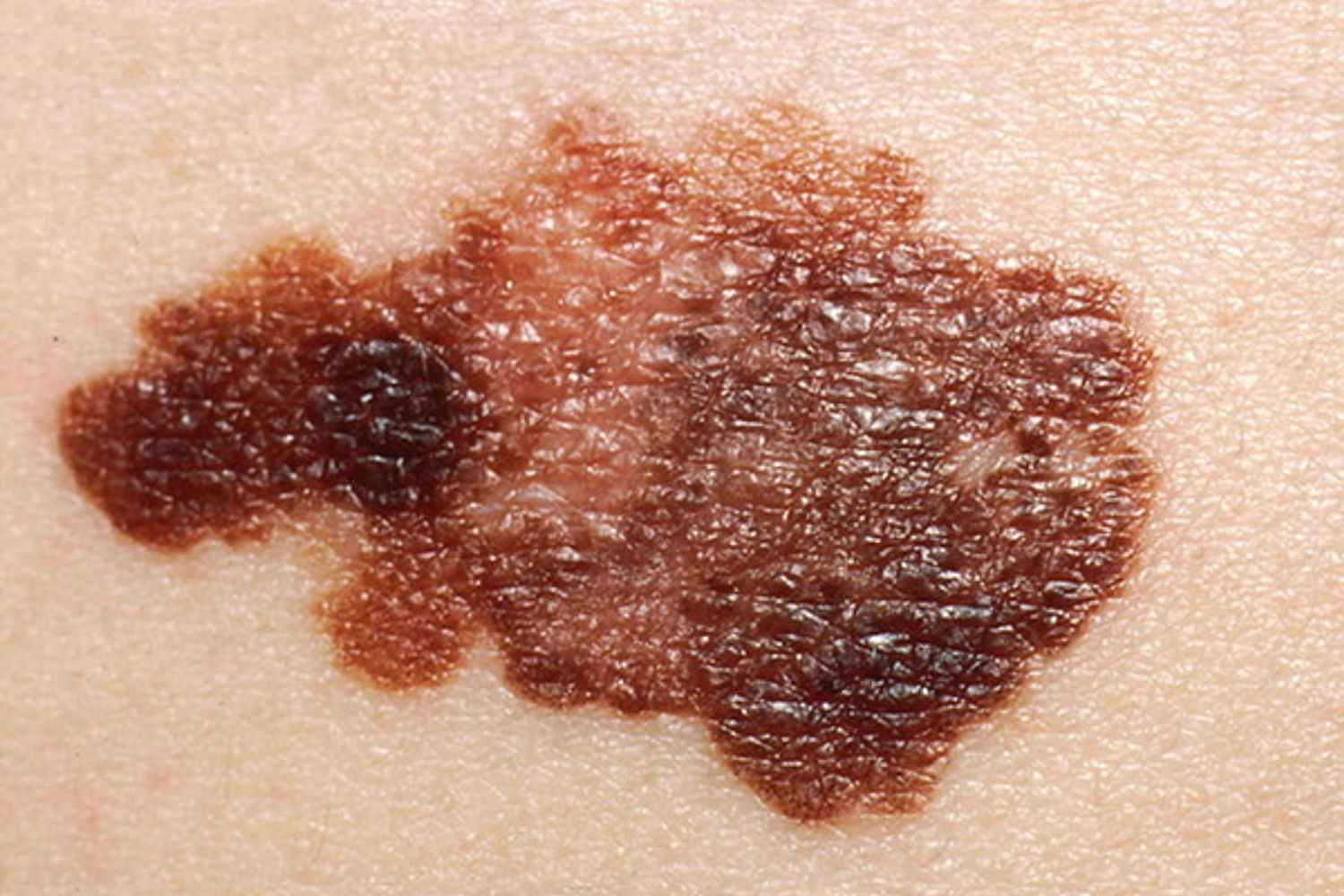 &nbsp;melanoma - afp
