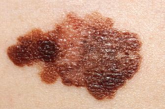 &nbsp;melanoma - afp