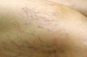 trombosi venosa&nbsp;