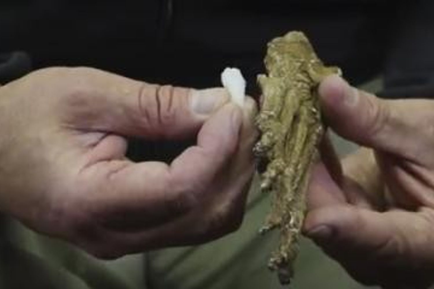 &nbsp;Osso piede umano cancro scoperta Sudafrica