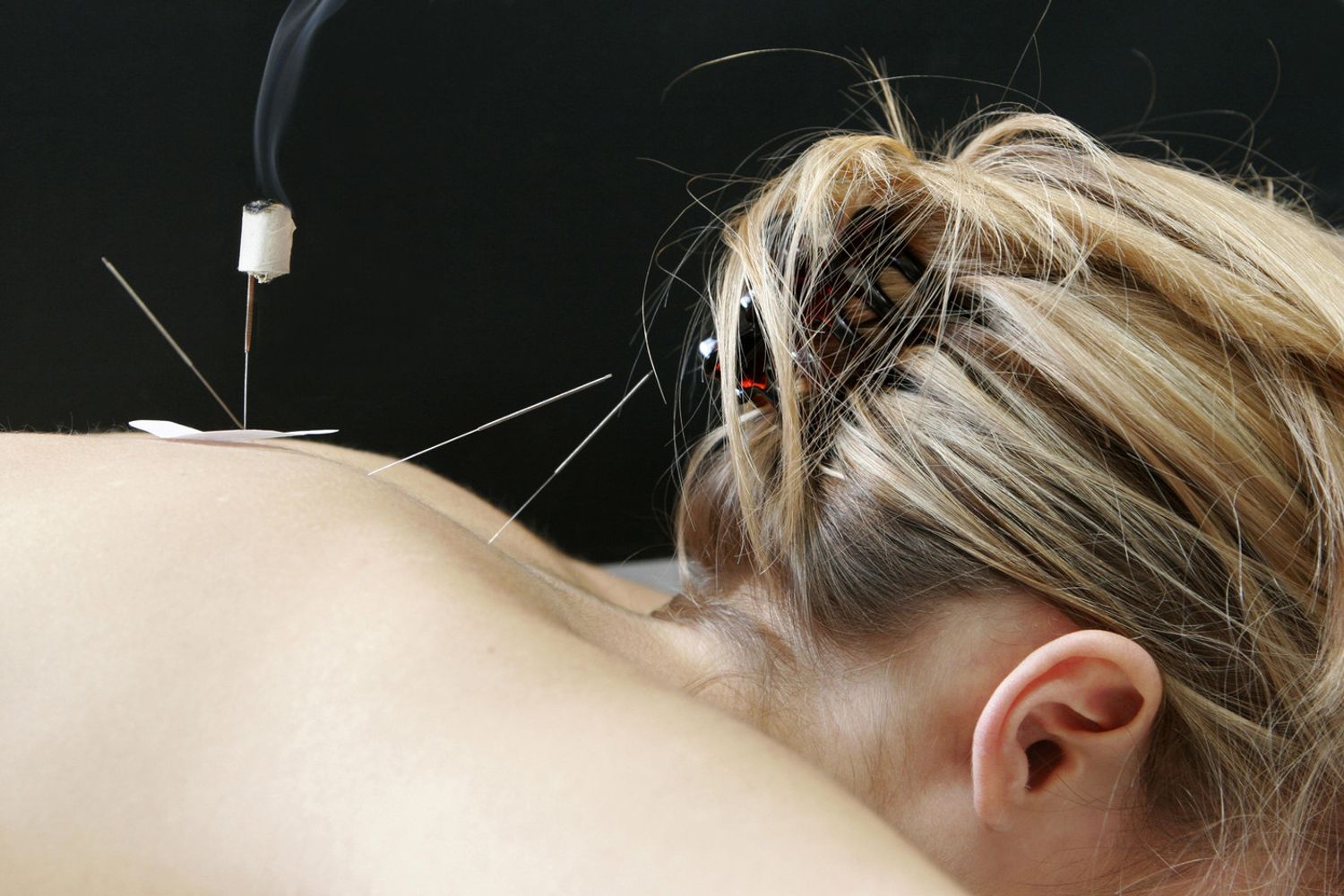 &nbsp;Agopuntura (Agf)