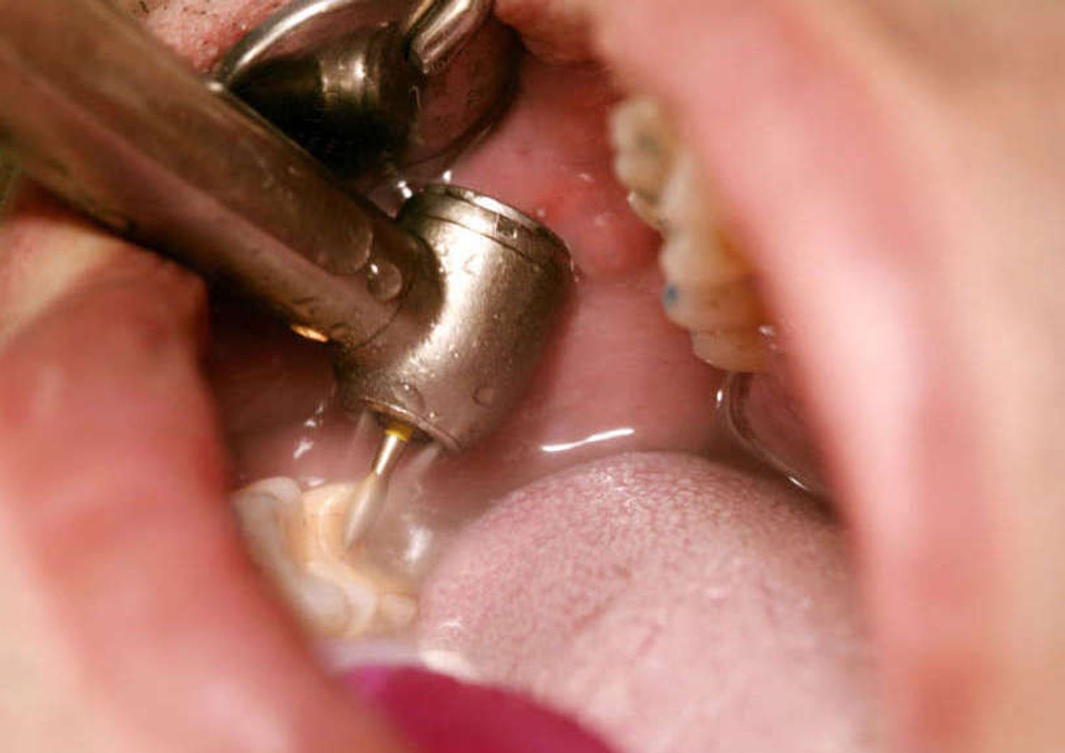 Aids: pazienti disposti a effettuare test rapido dal dentista