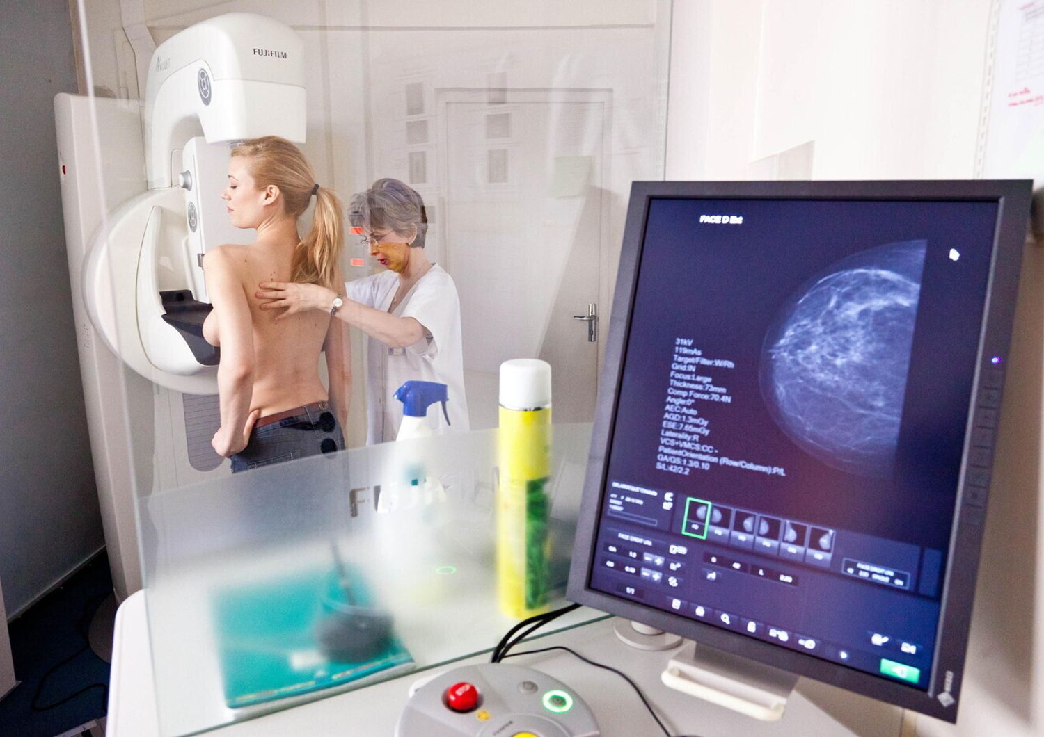 Tumore al seno - mammografia digitale (Agf)