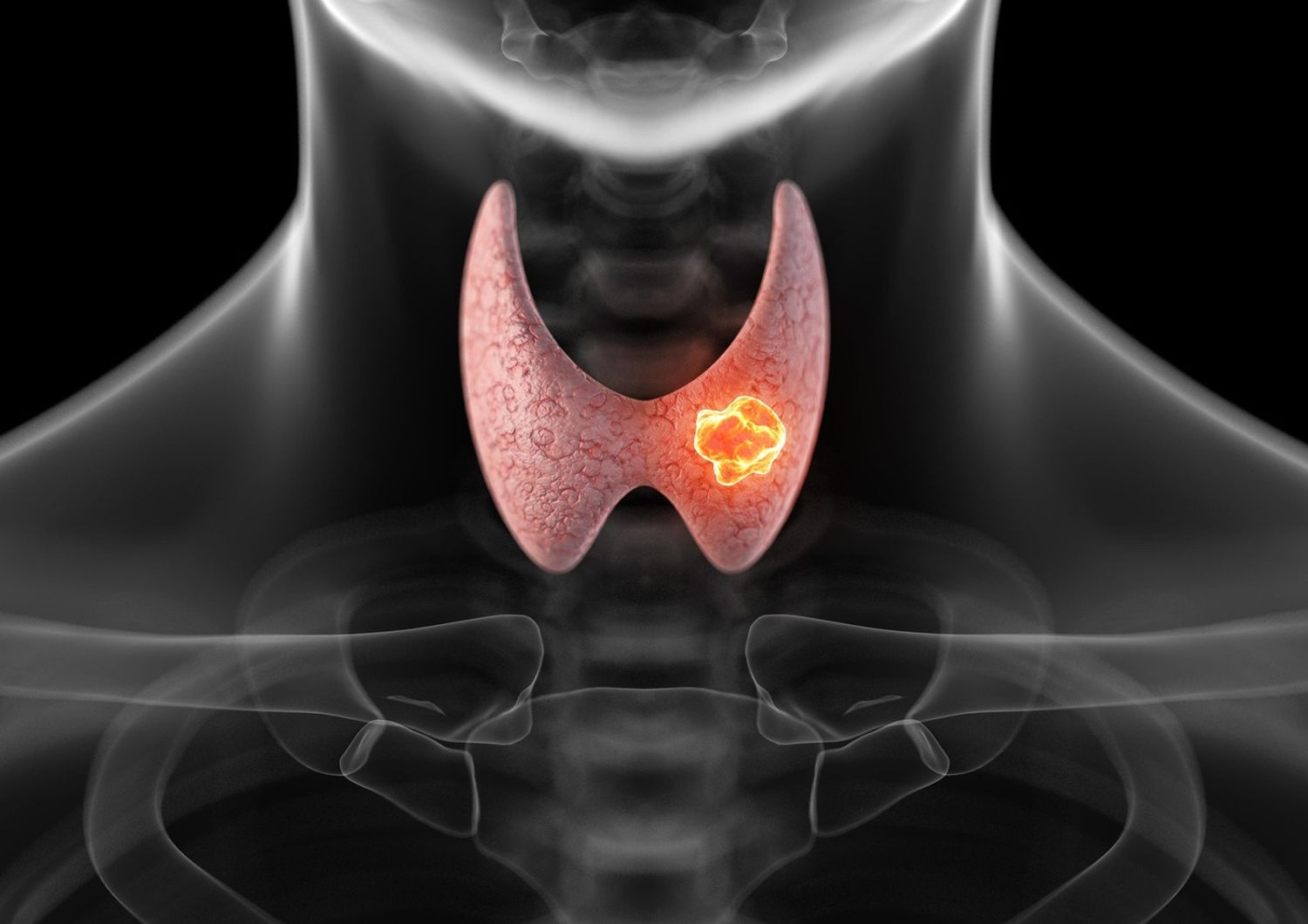 &nbsp;tumore alla tiroide (Agf)