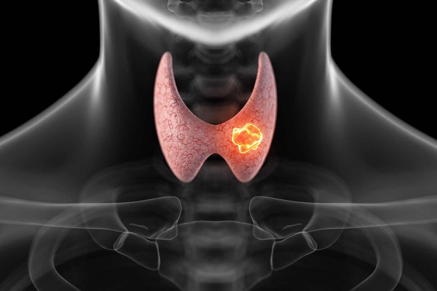 &nbsp;tumore alla tiroide (Agf)