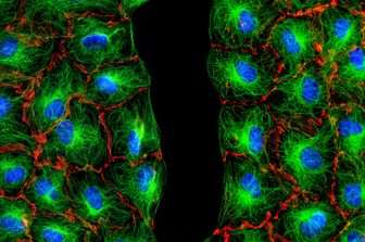 tumori - cellule fibroblasti (Agf)