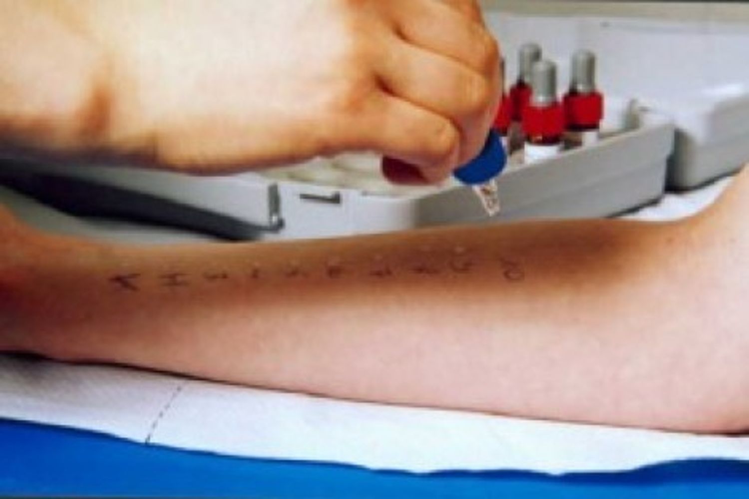 intolleranze alimentari allergie prove allergiche