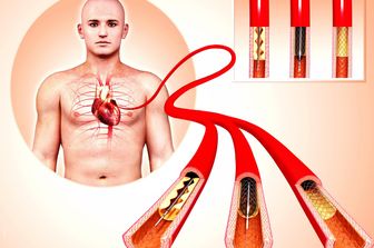 &nbsp; Angioplastica (Afp)