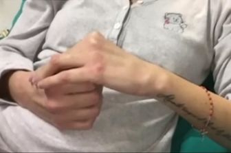 Gessica sfregiata dall&rsquo;ex posta video prima dell&rsquo;operazione&nbsp;