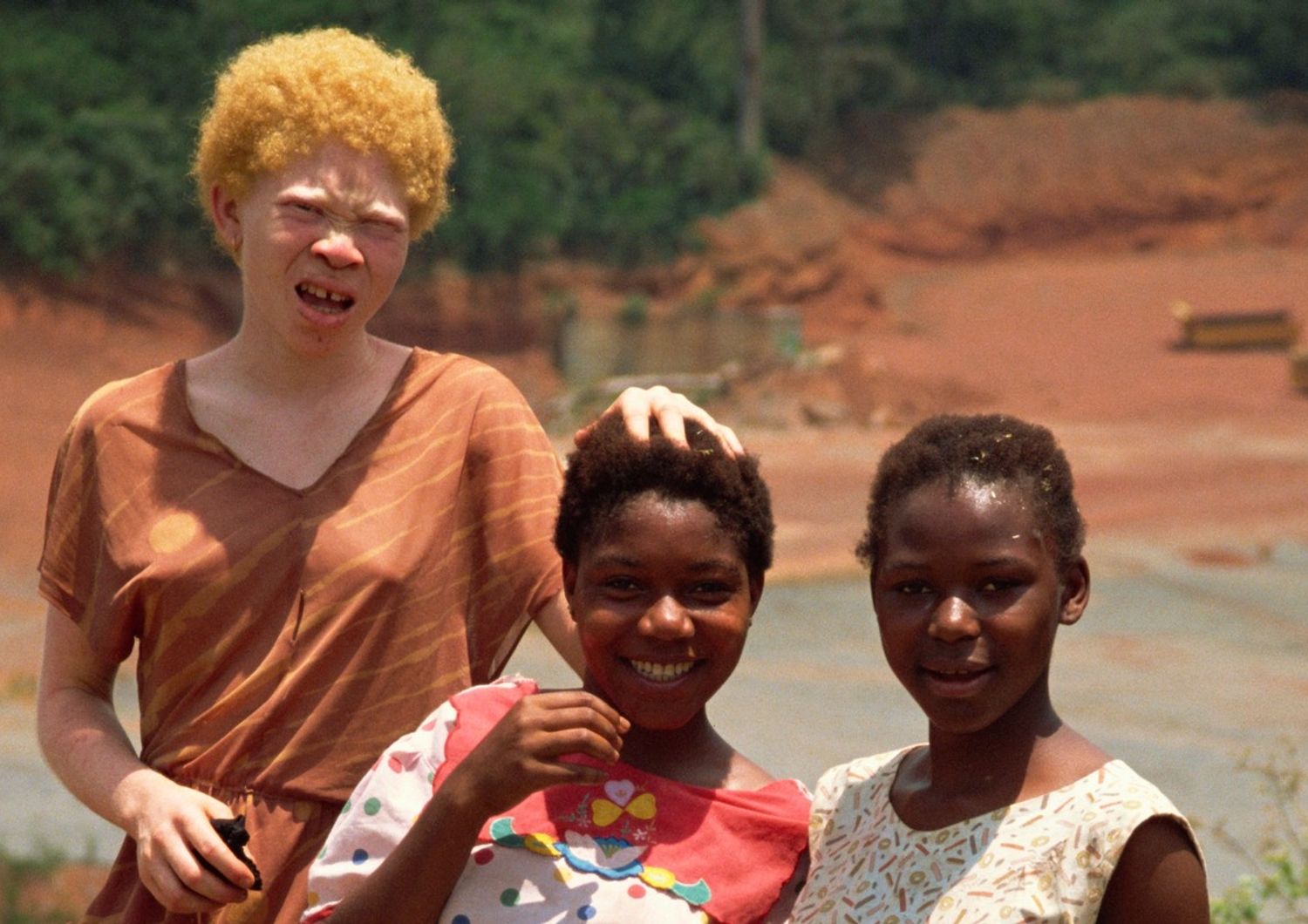 &nbsp;albini africani