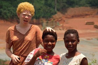 &nbsp;albini africani