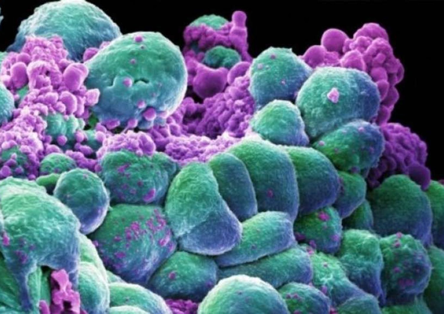 Aids: per la prima volta eliminato Hiv da cellule umane coltivate