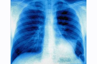 tumore polmone