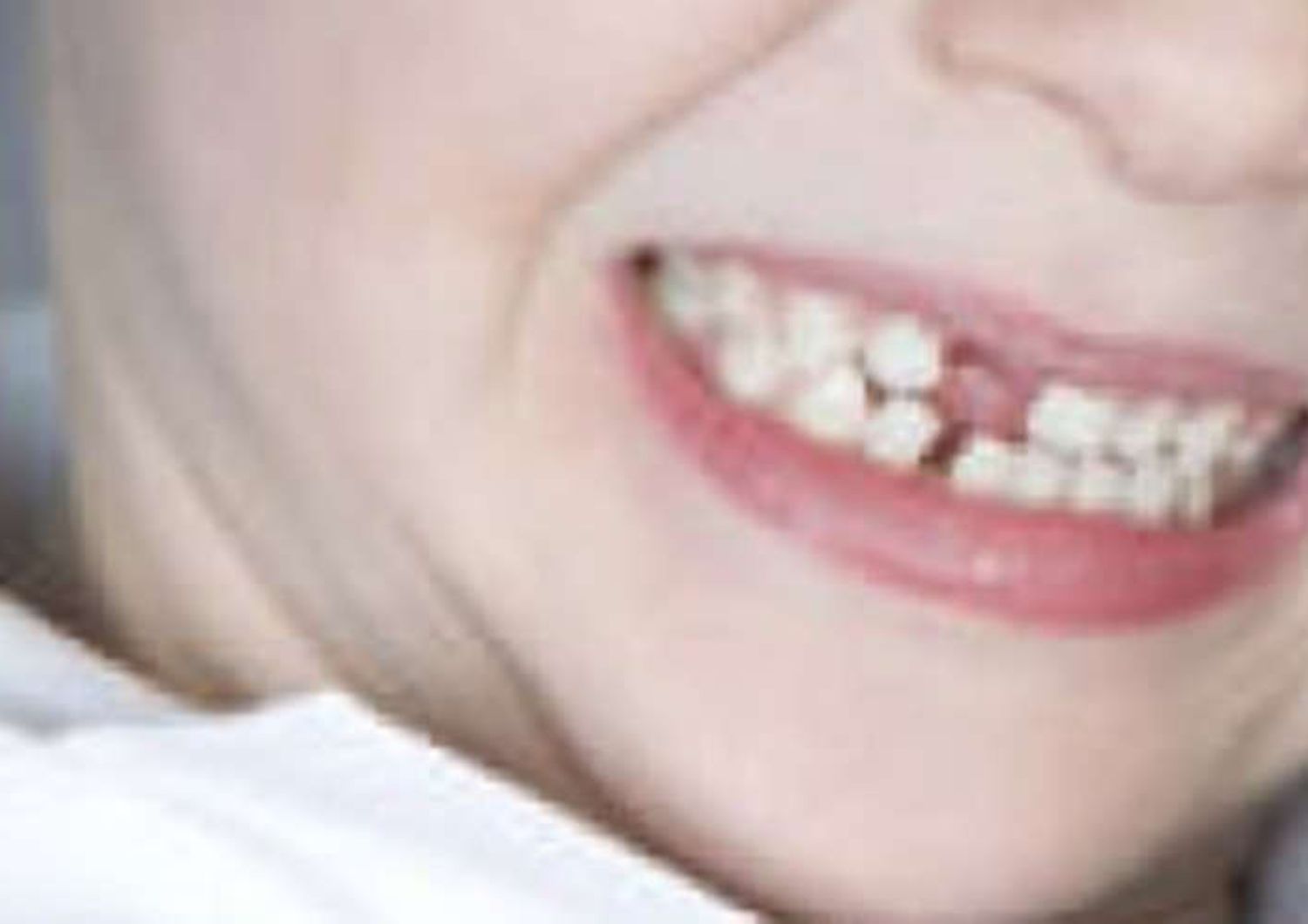 Estate: dentisti, ecco decalogo per proteggere sorriso bimbi