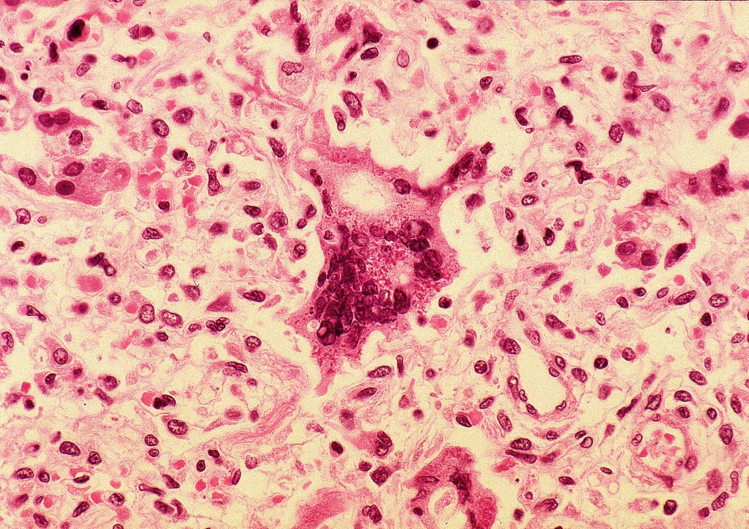Cella gigante del virus del morbillo vista sotto il microscopio a luce