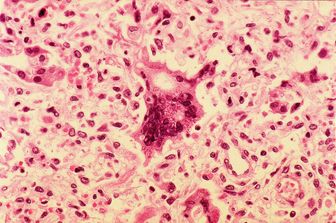 Cella gigante del virus del morbillo vista sotto il microscopio a luce