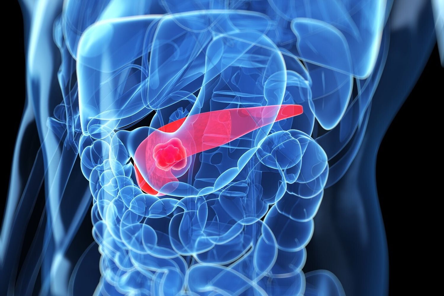 &nbsp;tumore al pancreas
