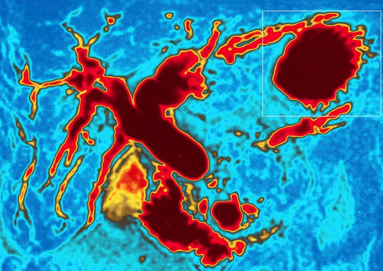 &nbsp;Colangiografia di un tumore al pancreas