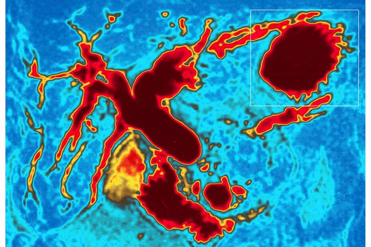 &nbsp;Colangiografia di un tumore al pancreas