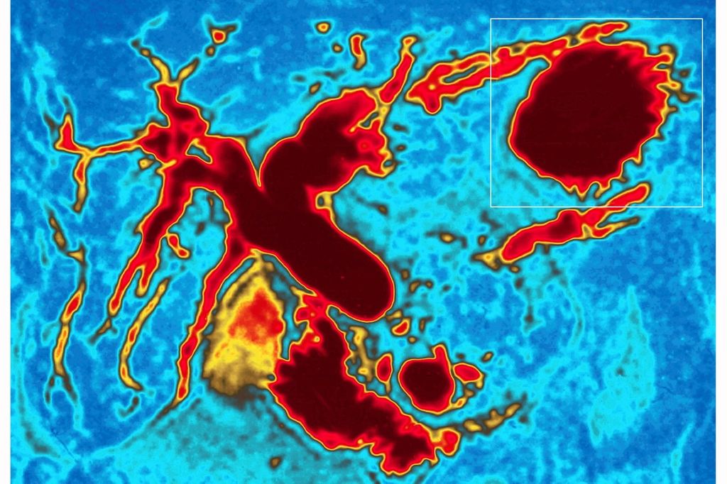 &nbsp;Colangiografia di un tumore al pancreas