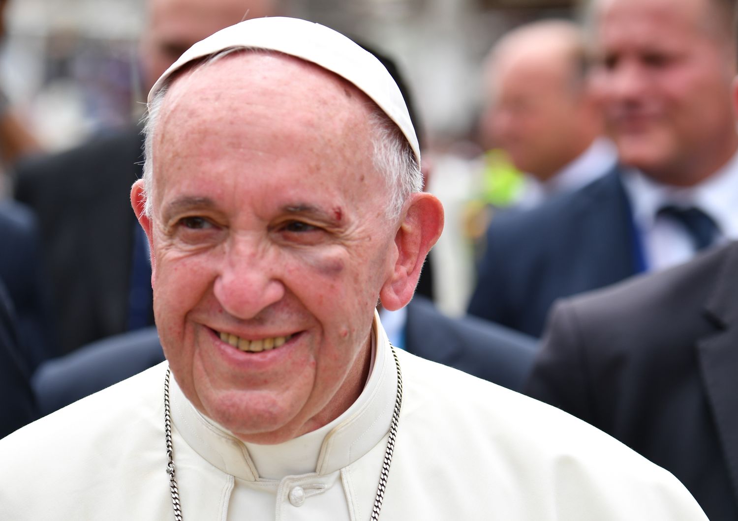 &nbsp;Il volto leggermente ferito di Papa Francesco a Cartagena