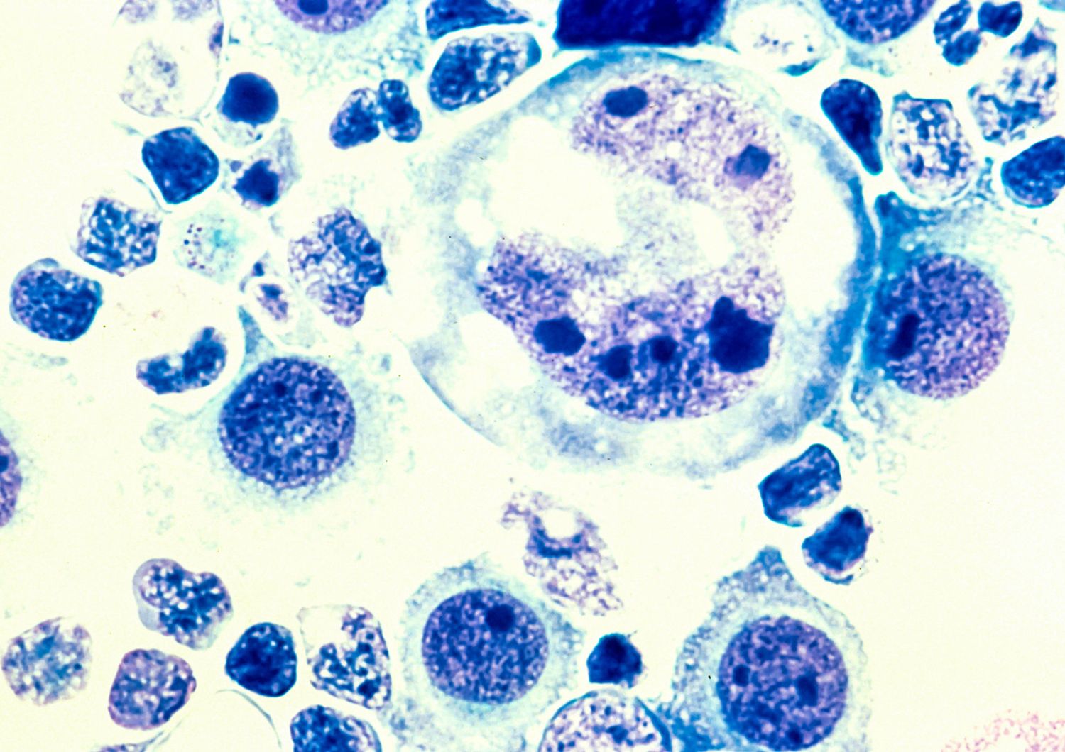 &nbsp;Cellule di un linfoma