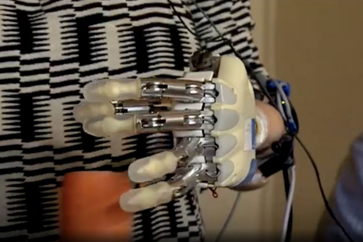 &nbsp;Mano bionica di Almerina Mascarello