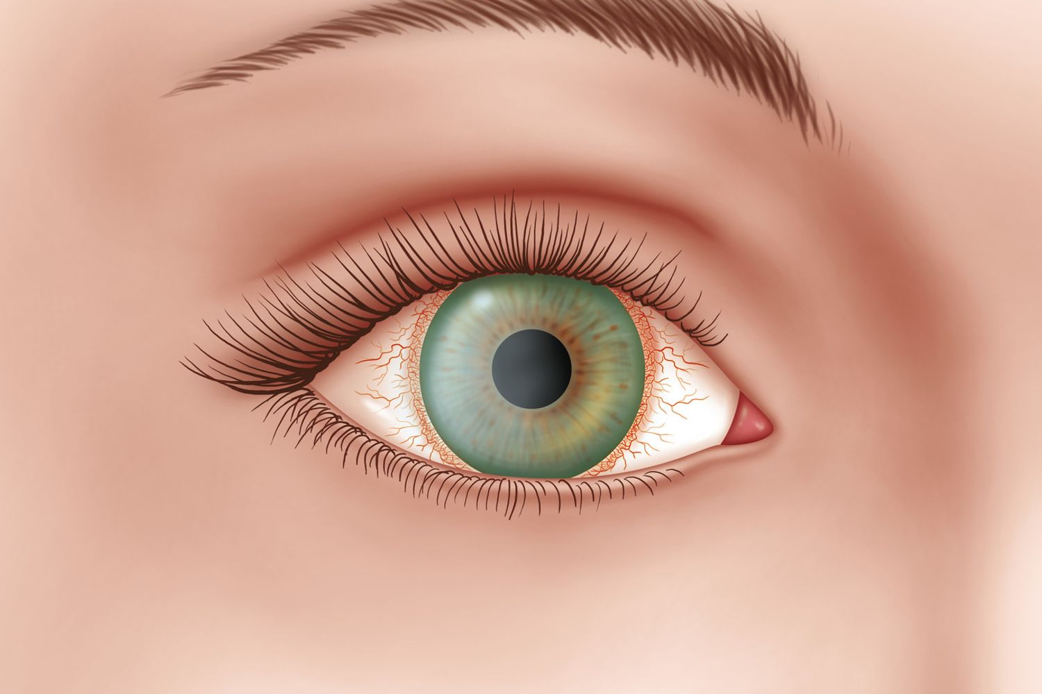 &nbsp;Una rappresentazione grafica della cheratite
